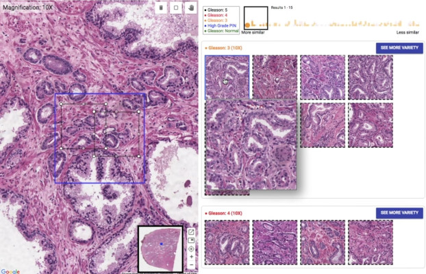 [NEWS] Google’s SMILY is reverse image search for cancer diagnosis – Loganspace